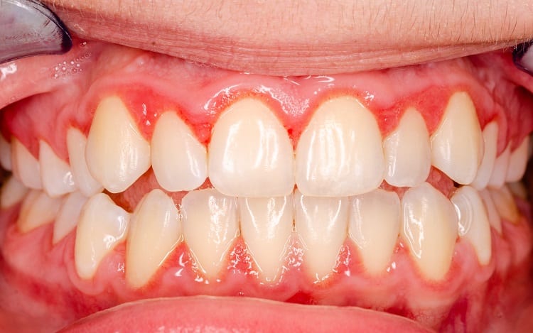 Viêm nướu là tình trạng viêm mô nướu bao quanh chân răng.