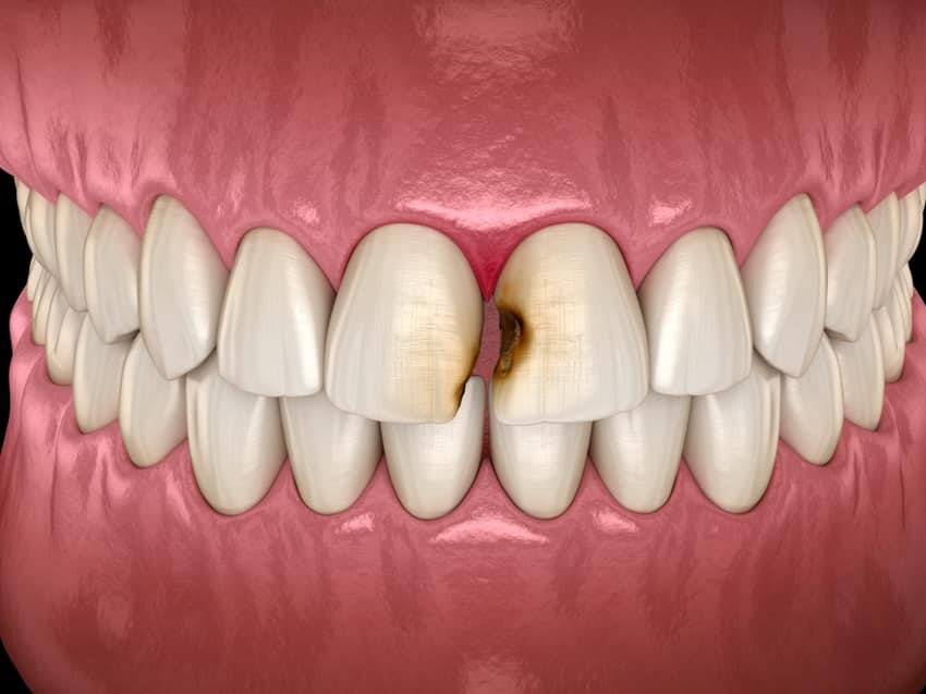Sâu răng cửa là tình trạng thường gặp