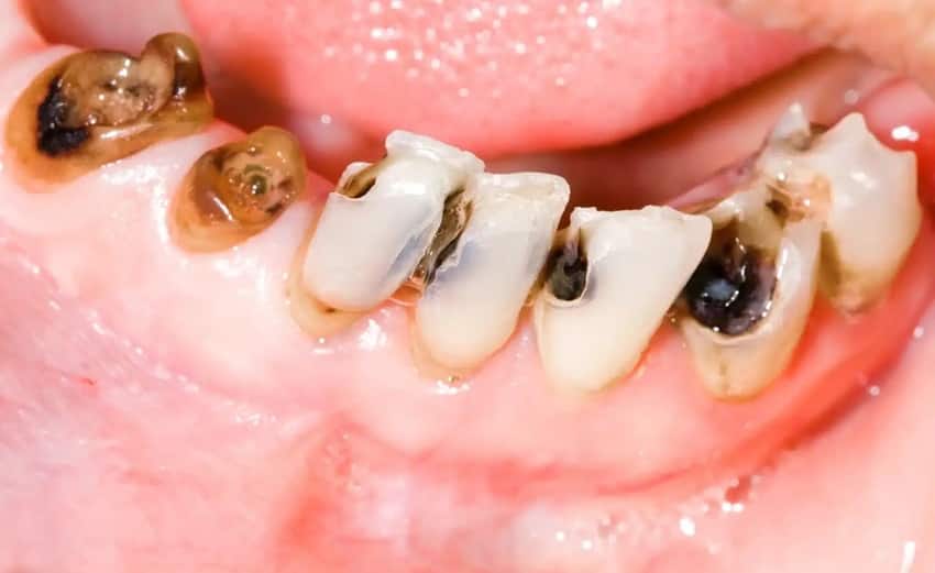 Dấu hiệu nhận biết sâu răng là những đốm đen