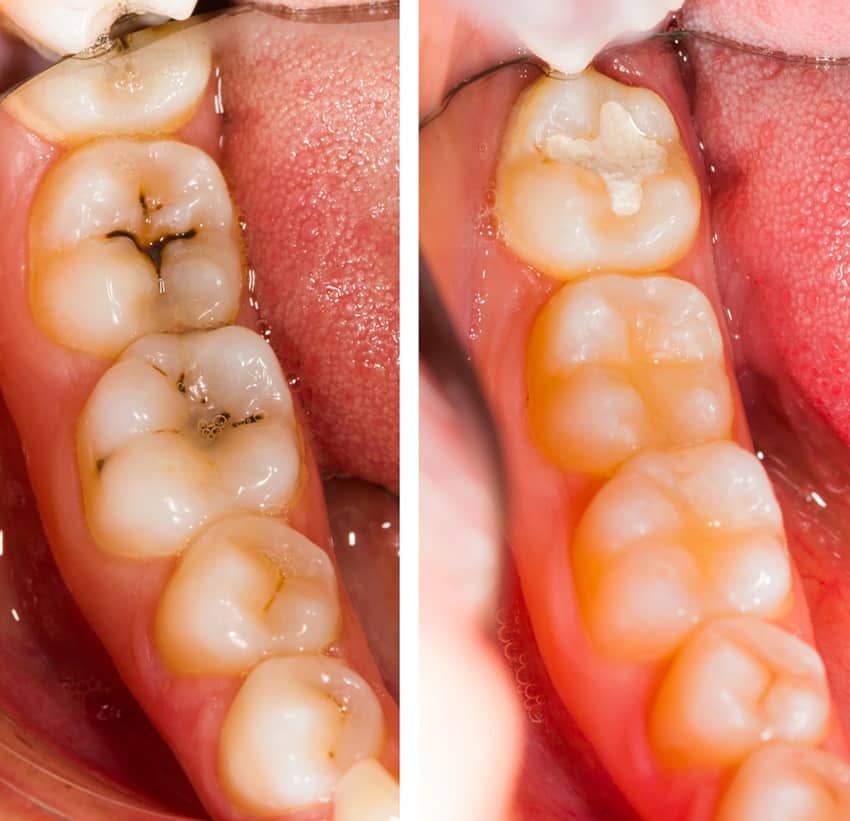 Trám răng để điều trị sâu răng