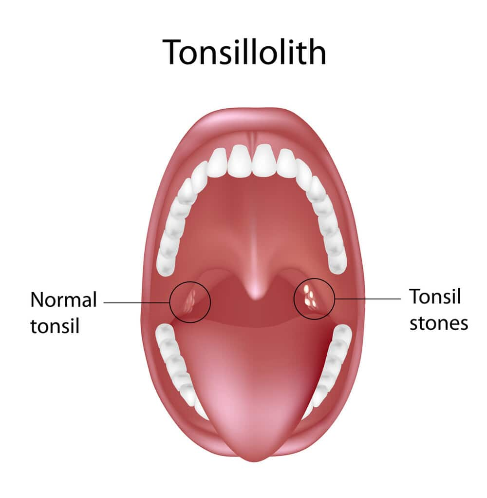 sỏi amidan hình thành do sự tích tụ vi khuẩn