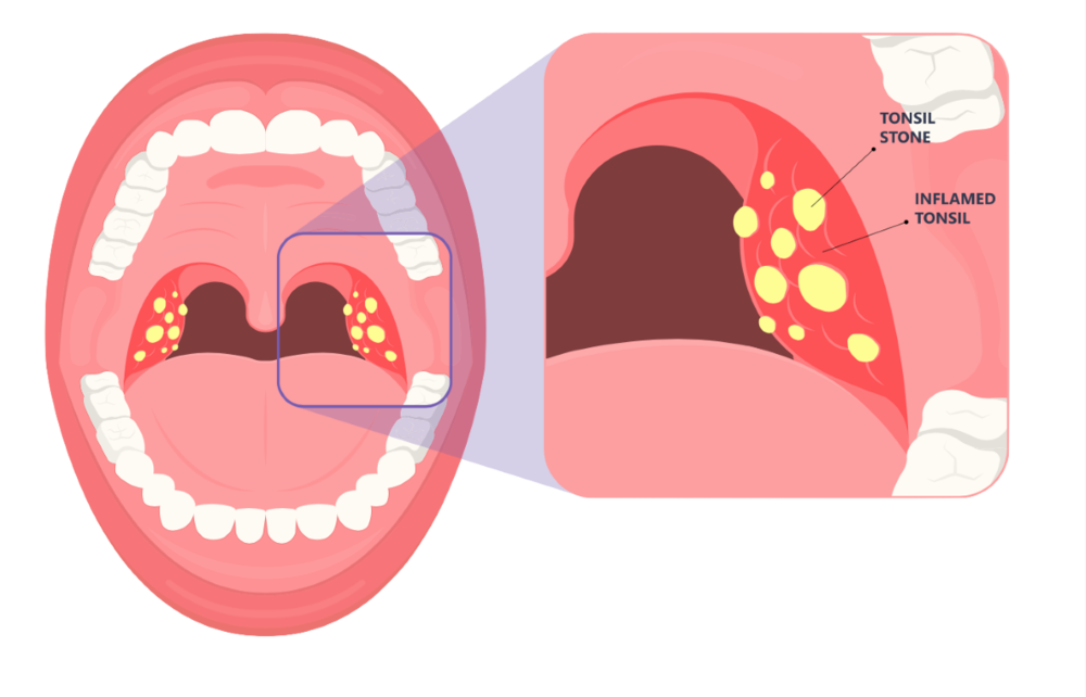 Sự khác biệt giữa sỏi amidan và viêm amidan