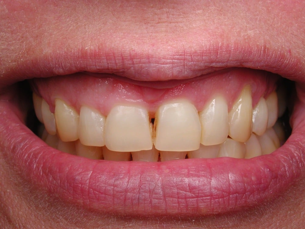 Sâu răng cửa là tình trạng vi khuẩn ăn mòn lớp men răng cửa