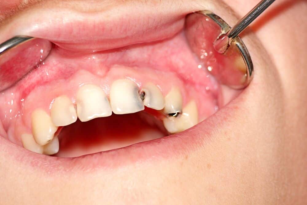 Răng cửa bị sâu thường có những đốm đen