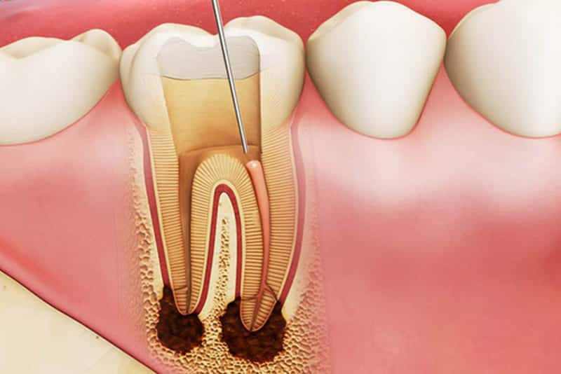 Sâu chân răng hàm