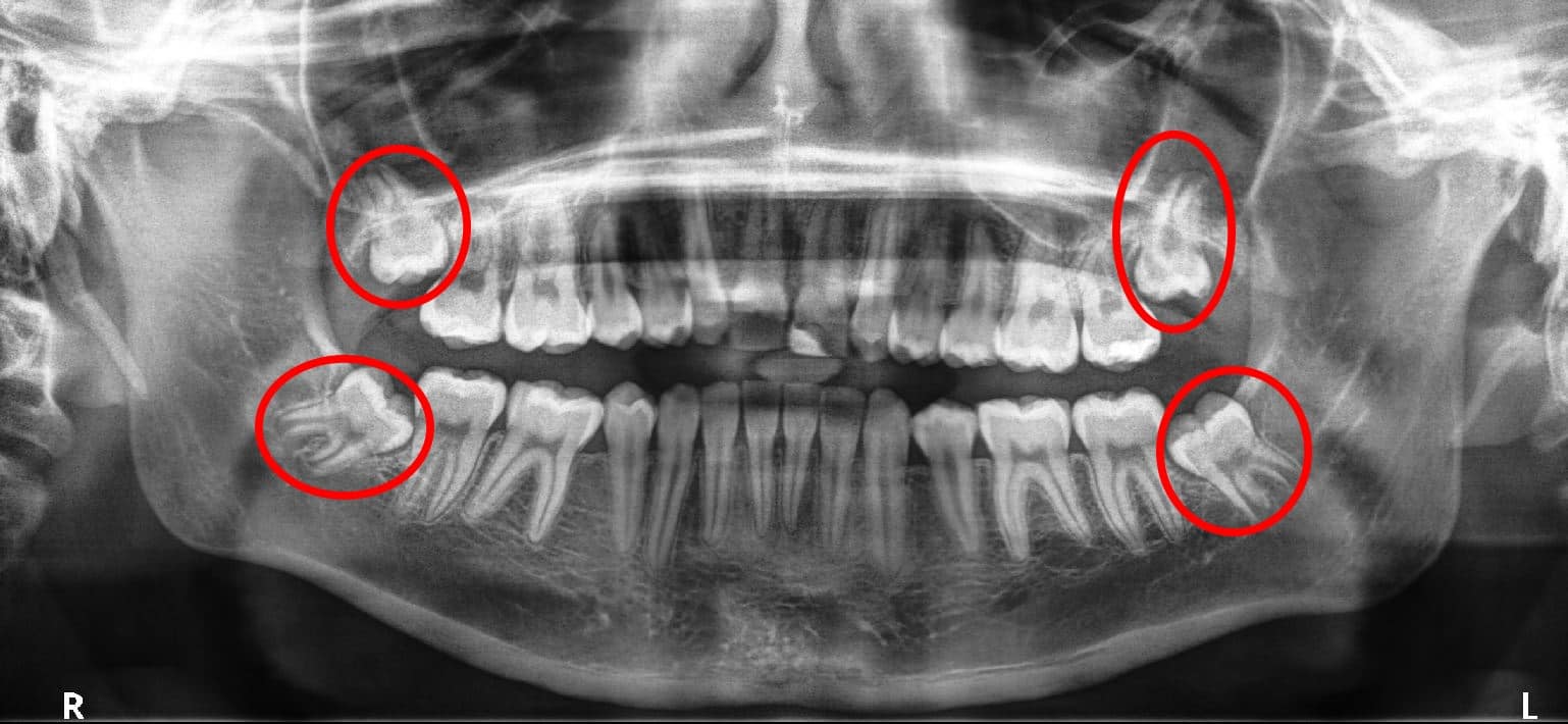 Hình ảnh răng khôn chụp x-quang