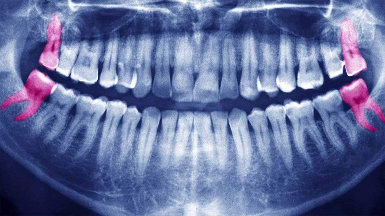 Tại sao con người lại có răng khôn?