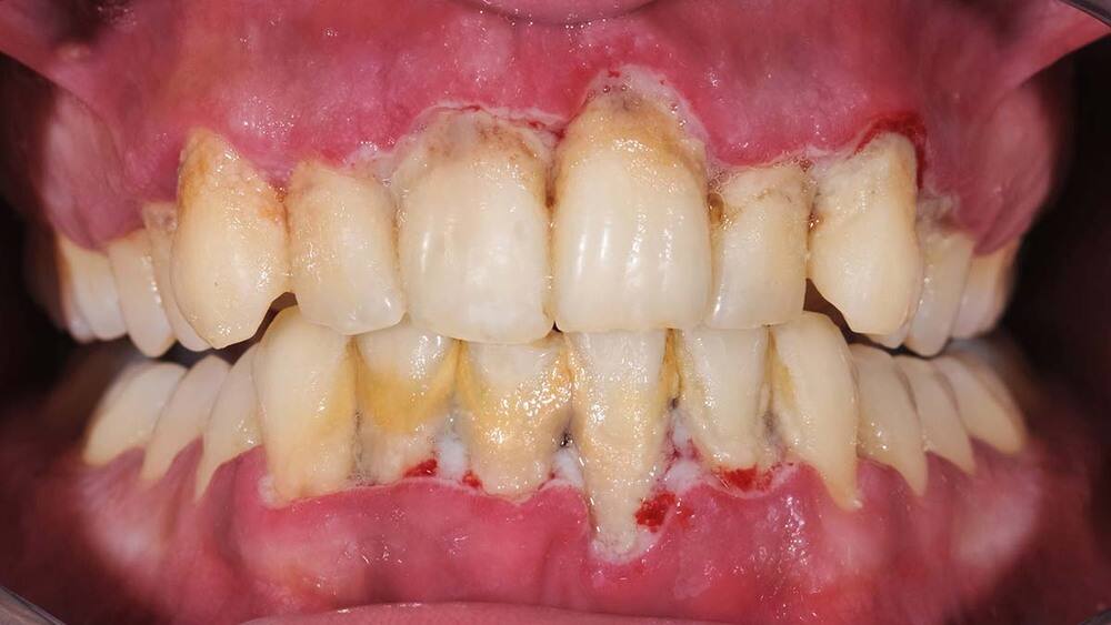 bệnh viêm nha chu (Periodontitis) là tình trạng viêm nhiễm mô nướu quanh răng 