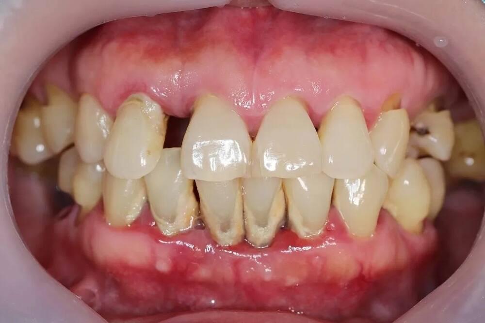 bệnh viêm nha chu bắt nguồn từ viêm nướu