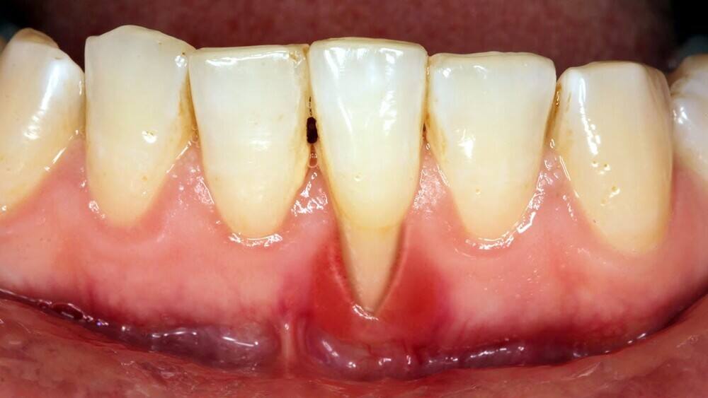  tụt lợi là biến chứng của viêm nha chu