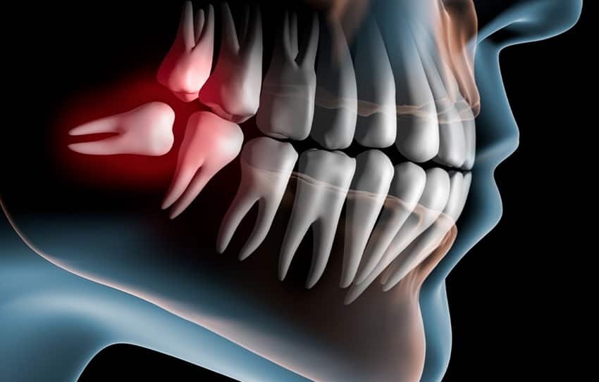 Tùy vào tình trạng răng khôn thì bác sĩ sẽ chỉ định nhổ
