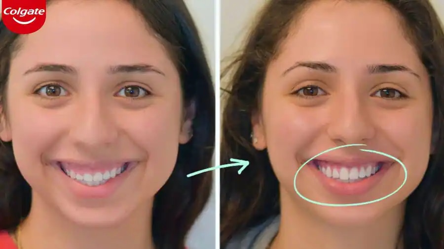 Cắt lợi có nguy hiểm không?