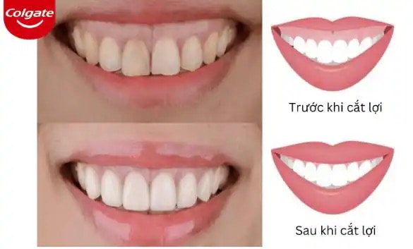 Phẫu thuật tạo hình nướu thẩm mỹ