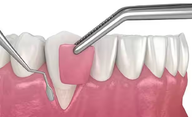 Phẫu thuật vạt nướu loại bỏ viêm nhiễm