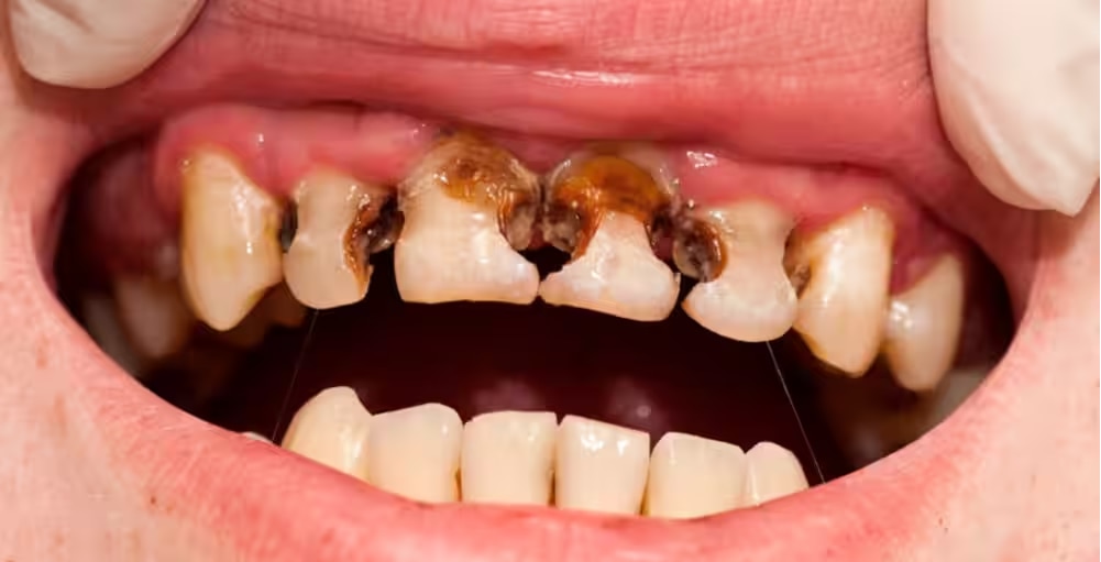 black tartar on teeth