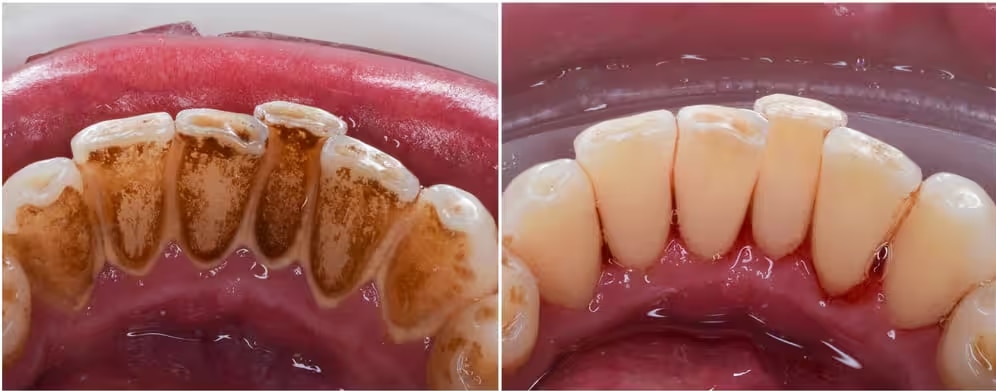 black tartar on teeth