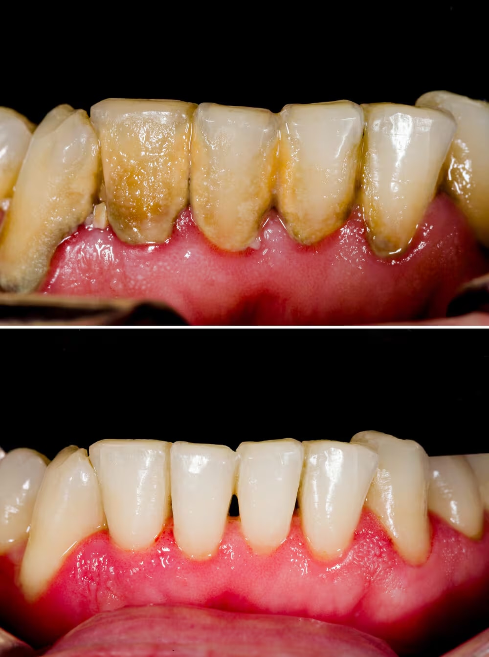 black tartar on teeth