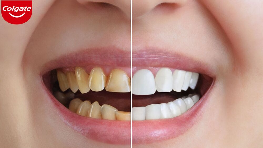 Cách tẩy trắng răng ố vàng tại nhà hiệu quả