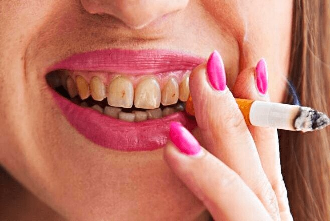 Hút thuốc lá làm răng bị vàng, xỉn màu