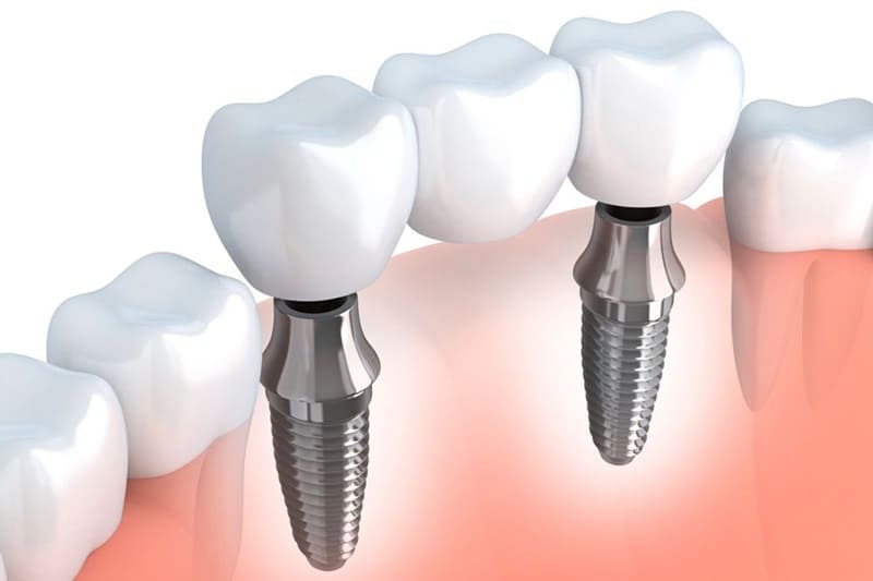 Cầu răng sứ trên trụ Implant