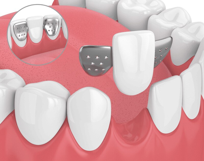 Hình ảnh cầu răng sứ cánh dán