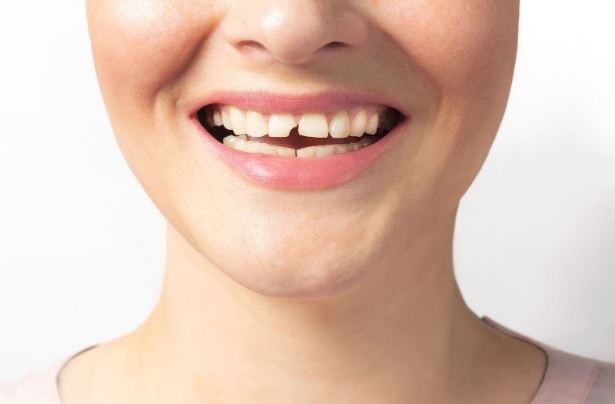 Răng bị mẻ do tác động lực mạnh, men răng yếu, bị sâu răng