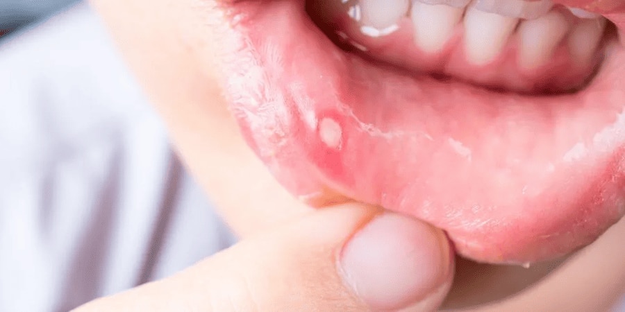 Dấu hiệu bị lở miệng, loét miệng