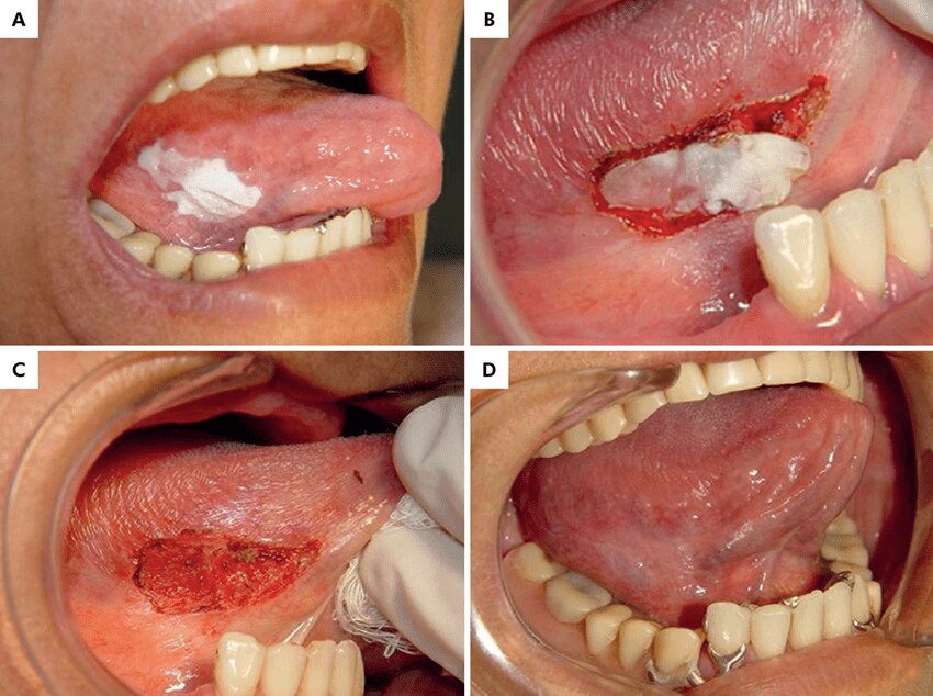 Điều trị bệnh bạch sản bằng phương pháp laser