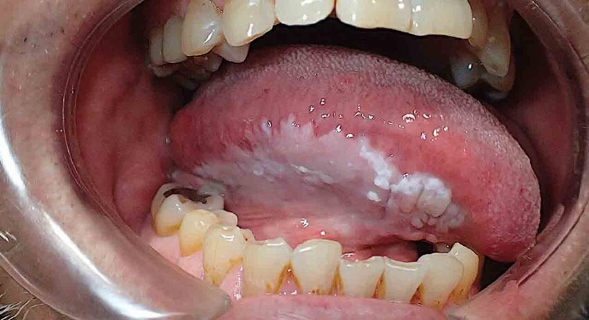 Bệnh bạch sản lông miệng (Oral hairy leukoplakia)