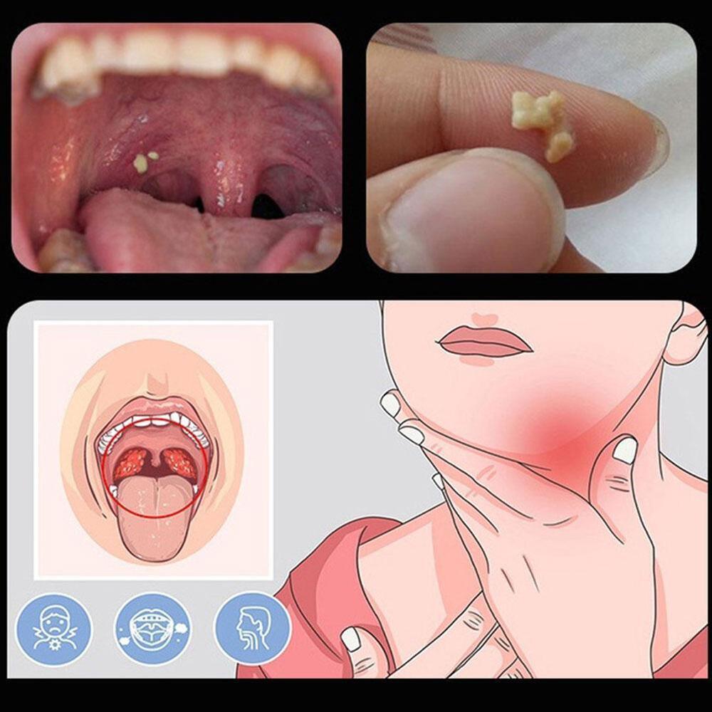 Sỏi Amidan Là Gì?
