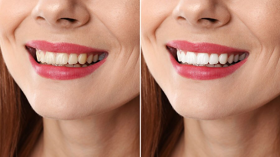 Chi phí làm trắng răng trước và sau khi thực hiện